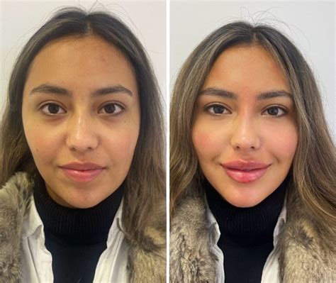 full face nuo advance aesthetic