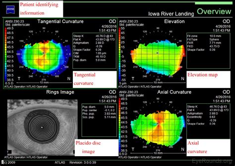 Normal Corneal Topography