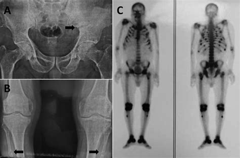 Tenofovir‐induced Osteomalacia Plain Radiographs Of Pelvis A And Download Scientific Diagram