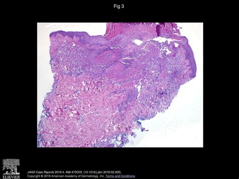 An Acneiform Eruption Secondary To Iododerma Ppt Download