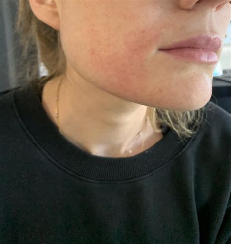 Does This Look Like Histamine Intolerance Rashes To You R