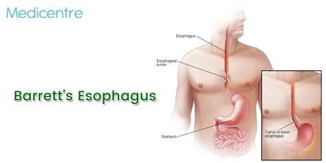 Barretts Esophagus Causes Symptoms Treatments