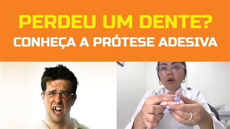 Perdi um dente e agora Conheça a Prótese Adesiva YouTube