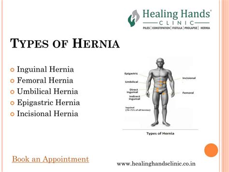 Ppt Hernia Symptoms Types And Treatment Powerpoint Presentation Free