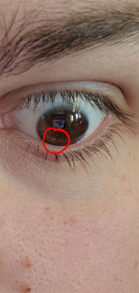 What is this white speck on my eye? It isn't moving around. It seems ...