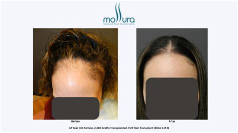 Female Hair Transplant Before & After Photos - Dr. Mollura - Long Island