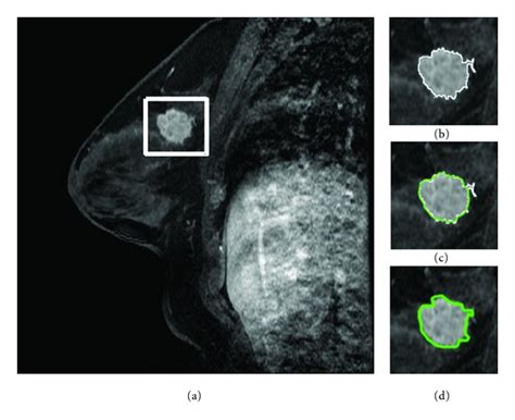 Lesion Segmentation On A Breast Mri Scan A Locate A Rectangle Roi