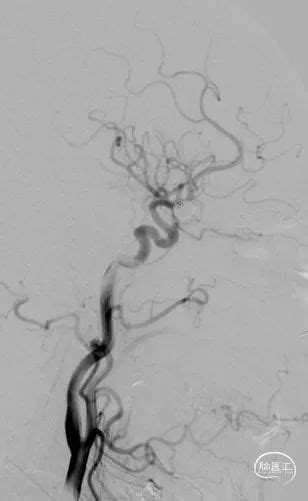 Atlas病例集 尤劲松：智能贴壁，宽颈克星 Atlas支架辅助栓塞mca分叉部复发宽颈动脉瘤 脑医汇 神外资讯 神介资讯