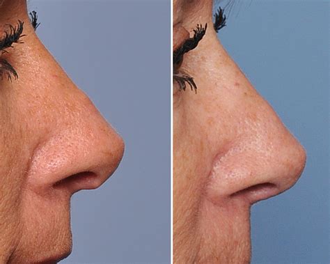 Alar Columellar Deformities And Their Treatment In Rhinoplasty Surgery