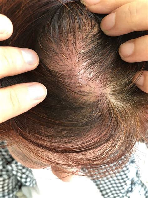 Allergic Contact Dermatitis Of The Scalp Caused By Hair Dye Download