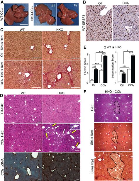 Deletion Of Splicing Factor Srsf In Hepatocytes Predisposes To