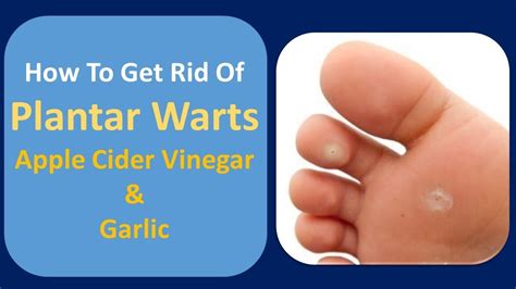 Plantar Wart Removal At Home Apple Cider Vinegar | Bruin Blog