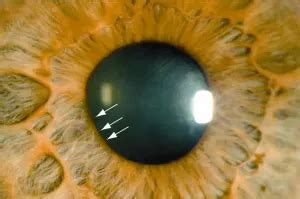 Adie tonic pupil - American Academy of Ophthalmology