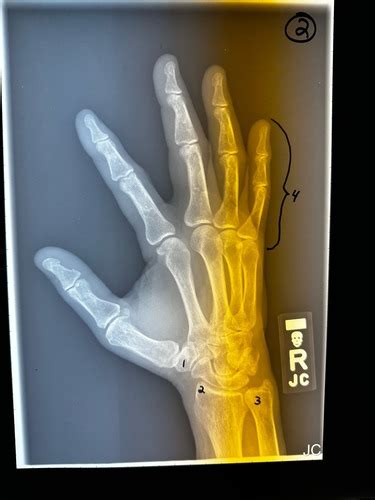 Hand Radiograph Self Test Flashcards Quizlet