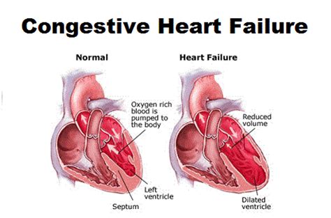 What is Congestive Heart Failure - Stages, Causes, Signs, Symptoms