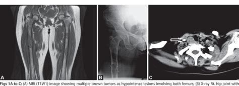 Figure 1 From Osteitis Fibrosa Cystica A Forgotten Entity Of Primary Hyperparathyroidism