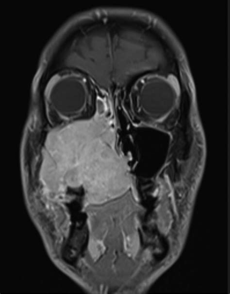 Fulminant Adenoid Cystic Carcinoma Of The Maxillary Sinus A Rare