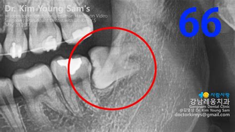 Surgical Extraction Of Horizontally Impacted 38 Lower Wisdom Tooth