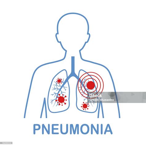 Penyakit Paruparu Pneumonia Paruparu Manusia Dengan Sel Virus Paruparu ...
