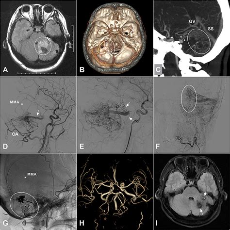 Frontiers Intracranial Dural Arteriovenous Fistulas With Brainstem