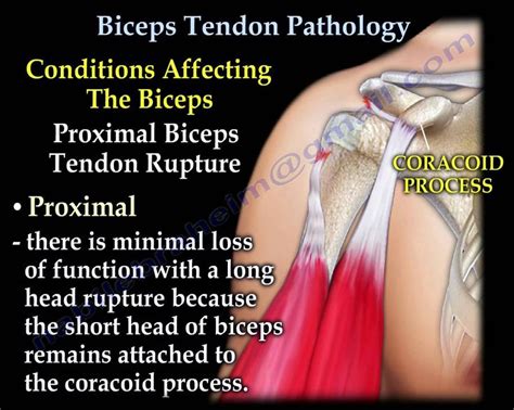 Biceps Tendon Pathology Everything You Need To Know Dr Nabil