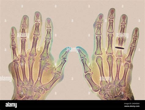 Bone Cancer Coloured X Ray Patients Hands Affected By Chondrosarcoma