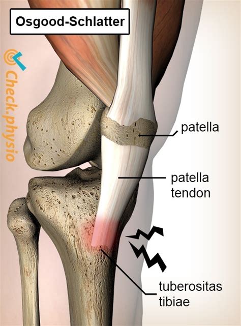 Osgood Schlatter Physio Check