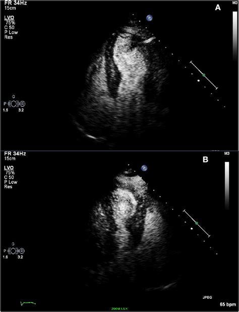 A B Transthoracic Echocardiogram With Definity Contrast