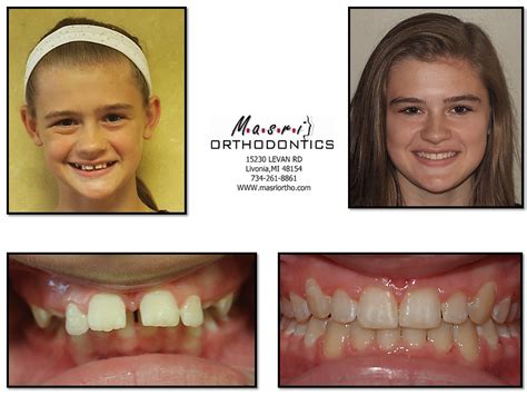 Braces Before And After Crowding