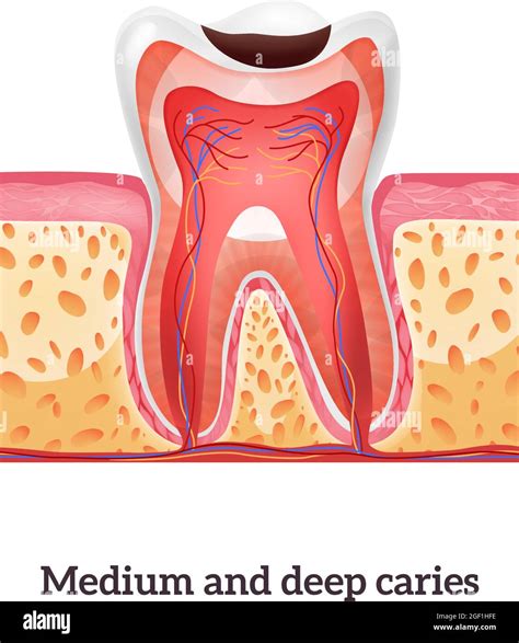 Estructura Dental Realista Con Ilustración Vectorial De Caries Media Y Profunda Imagen Vector De