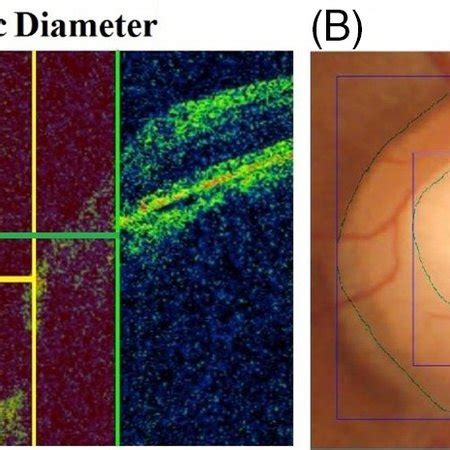 Oct And Fundus Image Of Od Portion Of Left Eye Of A Patient A Sdoct