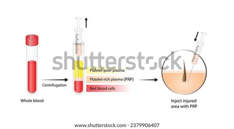 Plasma Injection Skin: Over 307 Royalty-Free Licensable Stock Vectors & Vector Art | Shutterstock