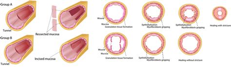 Illustration Of The Proposed Mechanism Of Esophageal Strictures