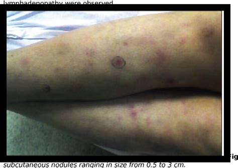 Figure 4 from Disseminated Mycobacterium avium-intracellulare infection in a person with AIDS ...