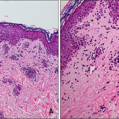 Histological Examination Of A Skin Biopsy Specimen From Patient