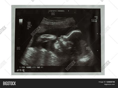 Ultrasound Picture Image & Photo (Free Trial) | Bigstock