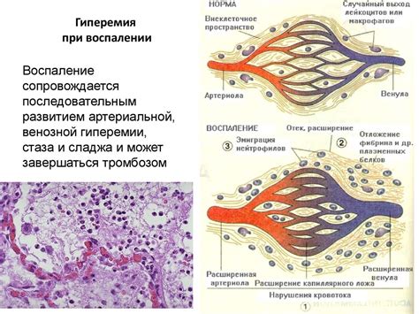Воспаление. Острое воспаление - online presentation