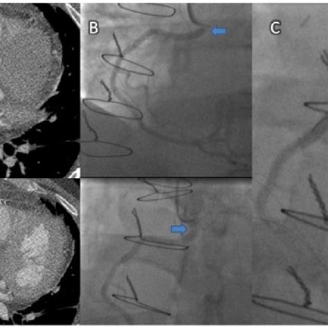 A 53-year-old man with a bicuspid aortic valve underwent elective... | Download Scientific Diagram