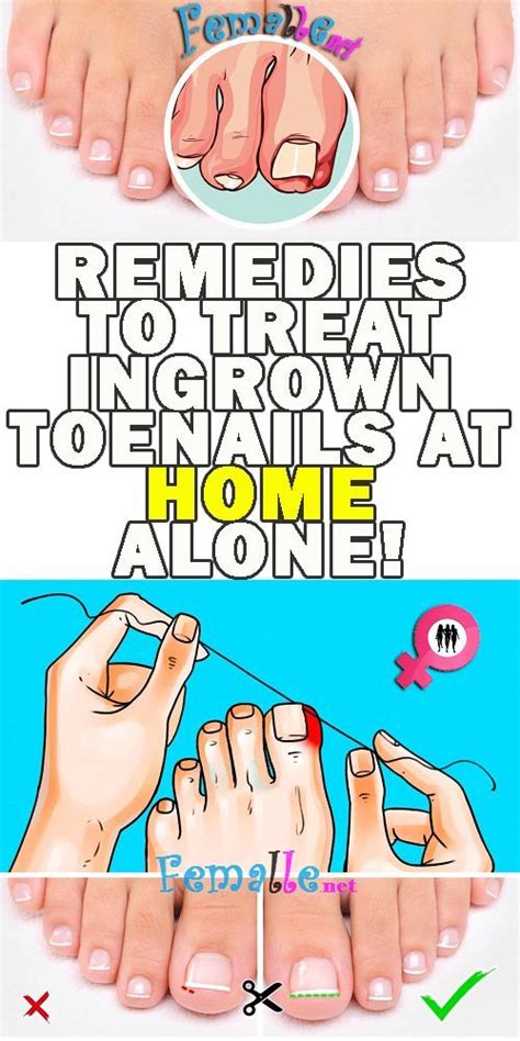 How To Remove Ingrown Fingernail - SAEROE