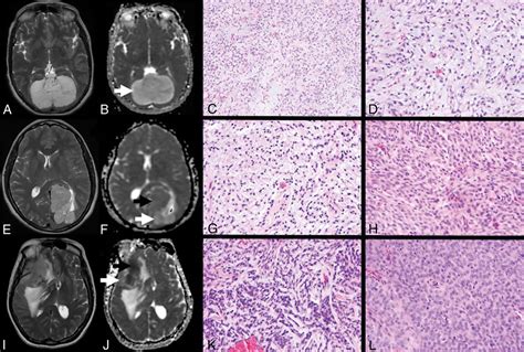 Meningioma Histology