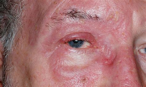 Mild Shingles On Face