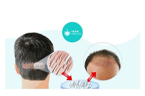 Hair Transplant In Iran The Best Cost Iran Health Agency