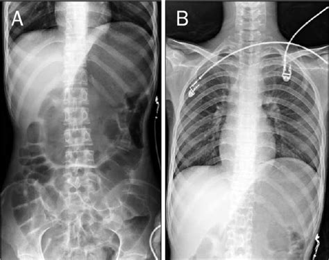 Figure 1 From A Case Of Gastric Emphysema In Anorexia Nervosa