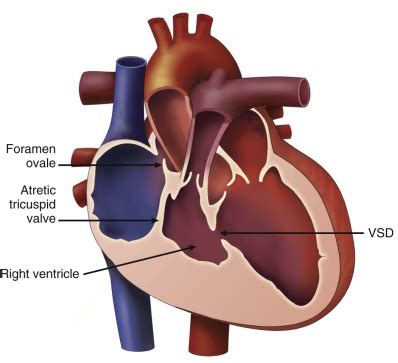 Tricuspid Atresia | Radiology Key