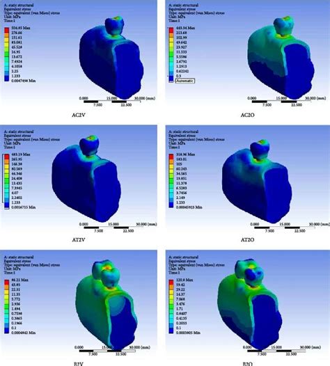 Von Mises Stress In Peri Implant Bone In Finite Element Models Of The Download Scientific