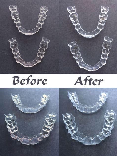 How To Take Care Of Invisalign Retainers