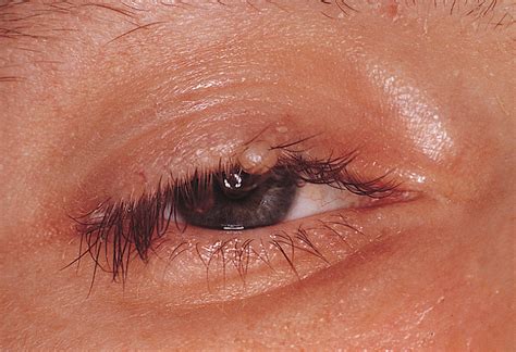 Eyelid Nodule: A Sentinel Lesion of Disseminated Cryptococcosis in a ...