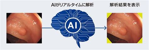 Aiで大腸内視鏡画像を解析する、内視鏡画像診断支援ソフトウェアを発売：医療機器ニュース Monoist