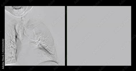 Angiogram Balloon Dialysis Catheter Inflated At Arteriovenous Av