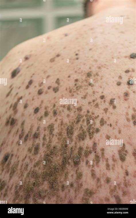 Mans back with mass of moles and infection Stock Photo: 129403700 - Alamy